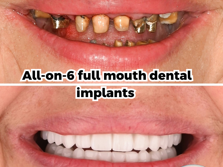 dental implants replace missing teeth naturally (4)